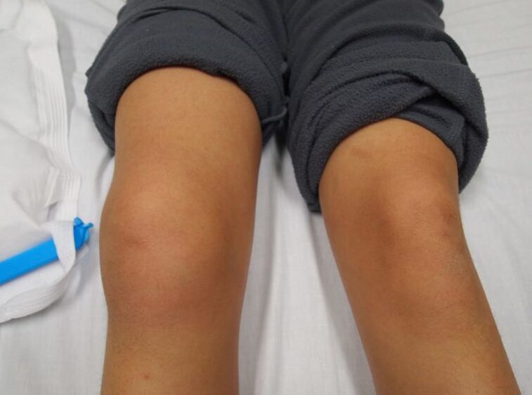 Kniegelenkdeformität mit Arthrose