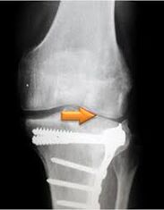 Kniegelenks -Osteoarthritis